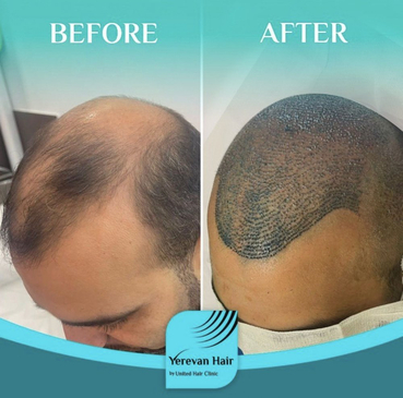 Slider image (6) United Hair Clinic